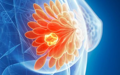 Breast Cancer in African American Women: Awareness, Prevention, and Hope