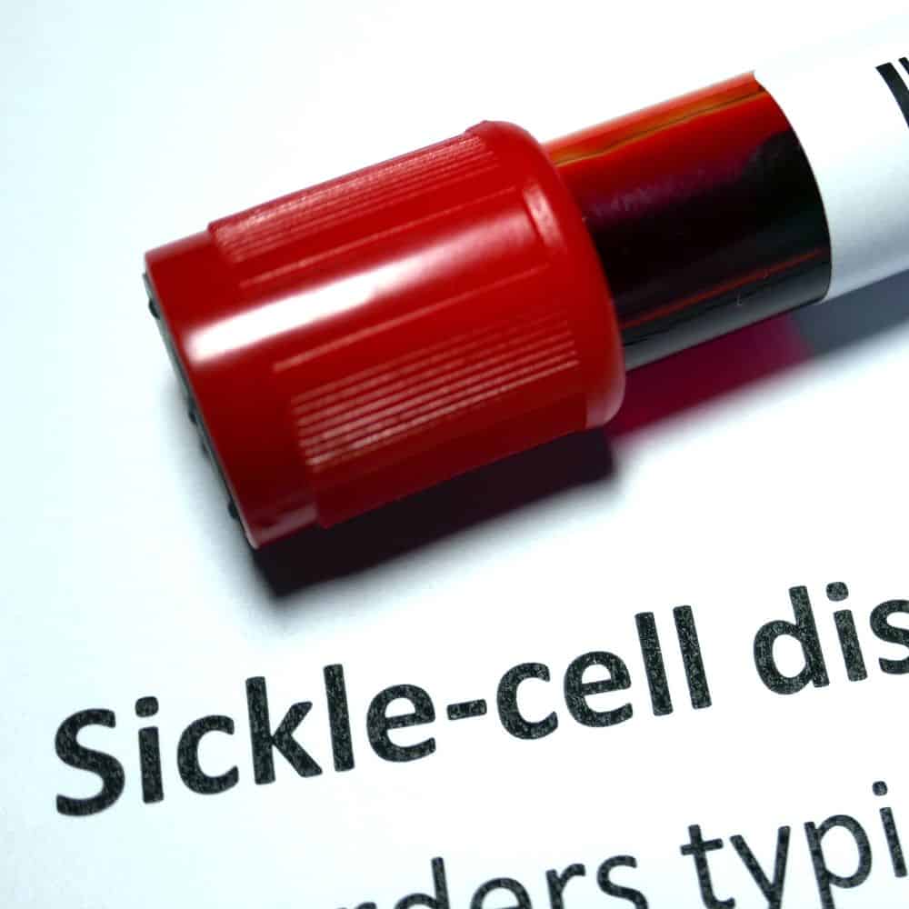 Understanding Sickle Cell Disease: What You Need to Know - Chi Eta Phi